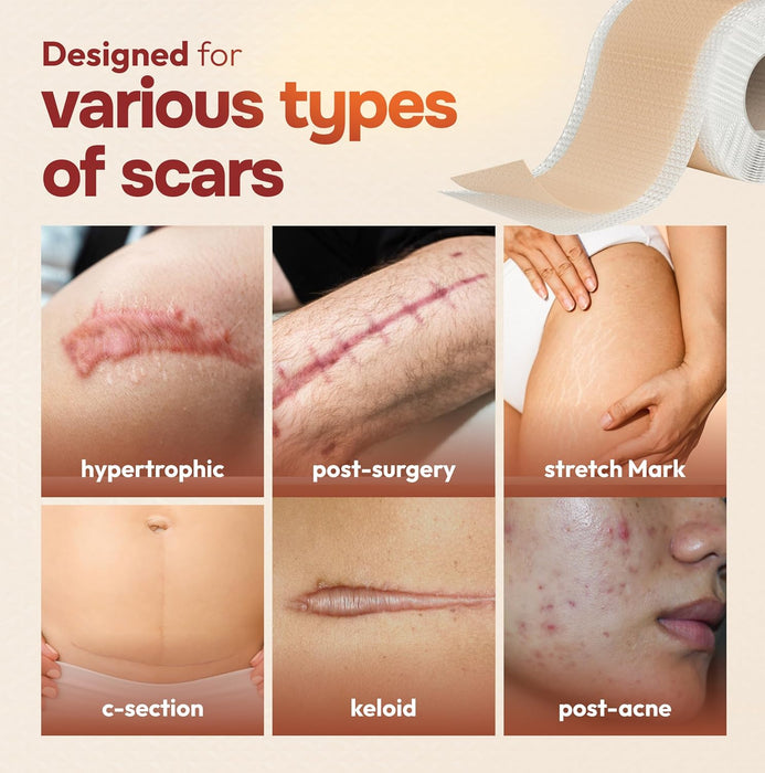 10 Pack Silicone Scar Sheets for Surgery & Stretch Marks