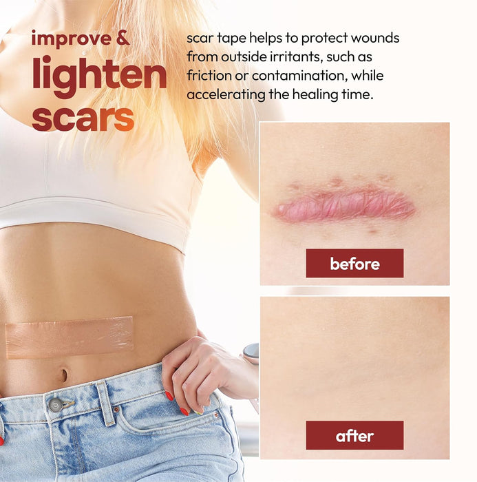 Silicone Scar Sheets – Medical Grade Reusable (6 Pack)