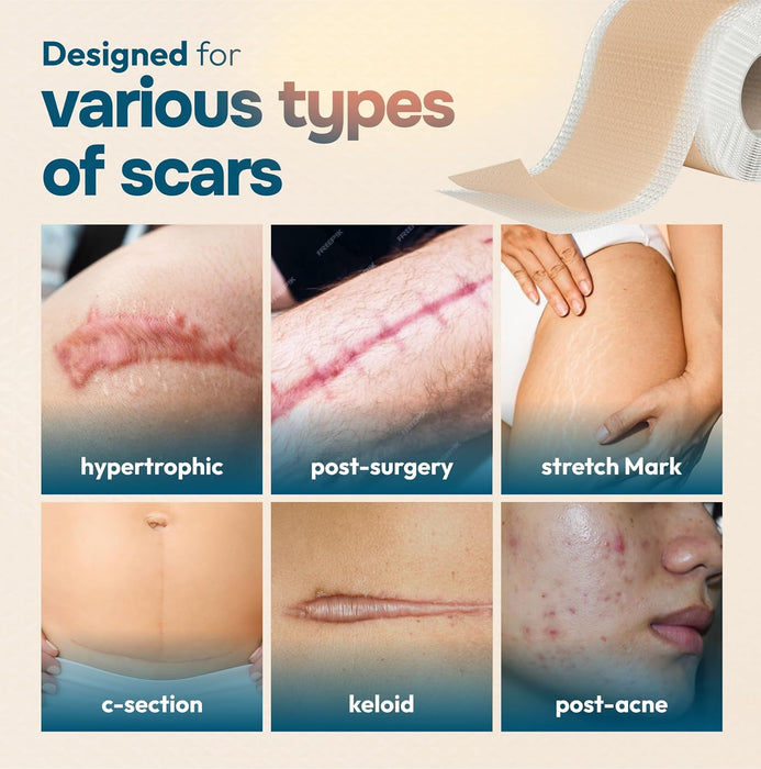 Silicone Scar Tape – Reusable Medical Grade Scar Sheets (60”)